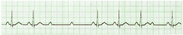 ACLS ECG Rhythm Strip 3