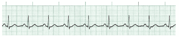 ACLS ECG Rhythm Strips