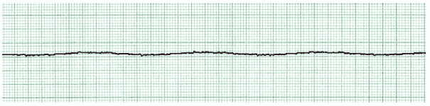 ACLS ECG Rhythm Strips 6