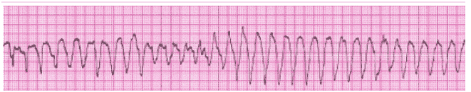 ACLS ECG Rhythm Strips Pretest Question