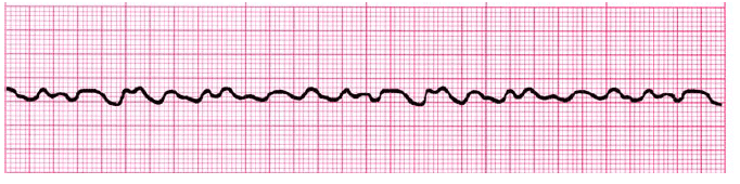 Acls Rhythms Practice Test 2020 Recognition Rhythm Strips