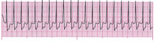 ACLS Pretest Questions and Answers 2024 (Full Practice Test)